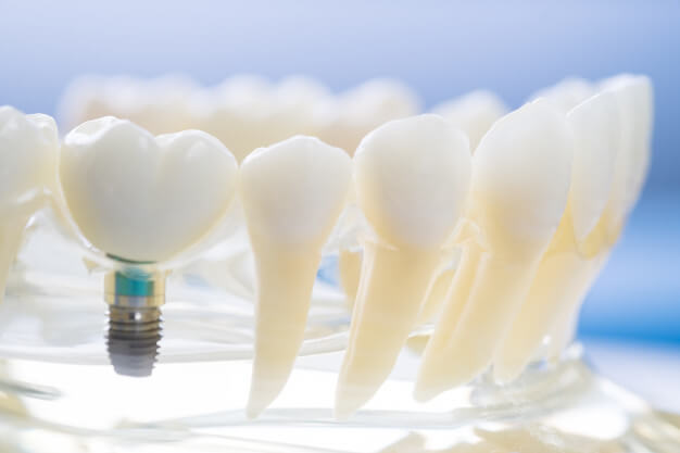 implantodontia protese dentaria na clinica odontologica