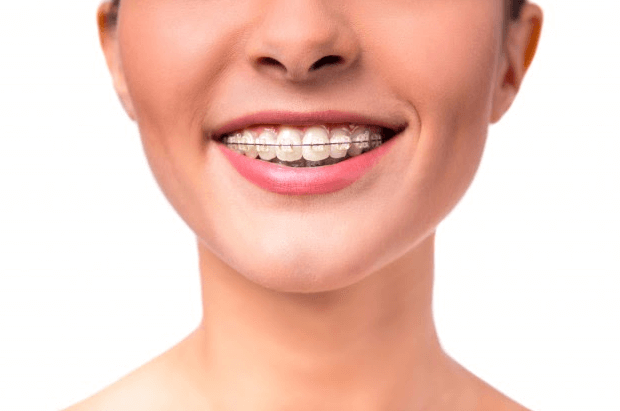 aparelho transparente dentes