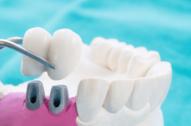 implante de dente gengiva