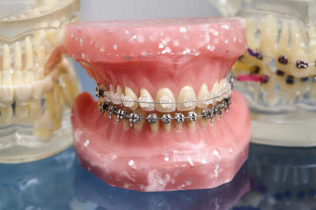 aparelho fixo dentadura