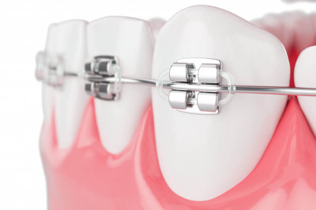 aparelhos ortodonticos dente