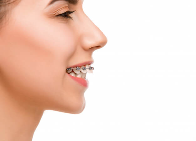 aparelhos ortodonticos perfil