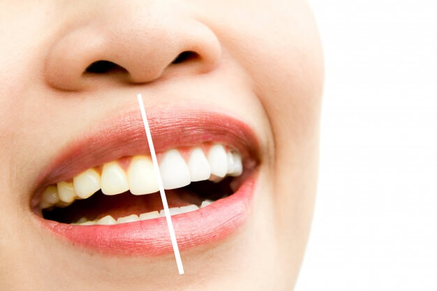 clareamento dental como funciona dentes antes e depois do procedimento