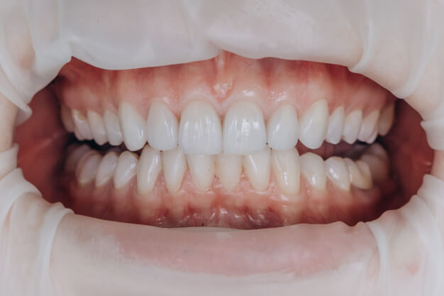 facetas de porcelana nos dentes