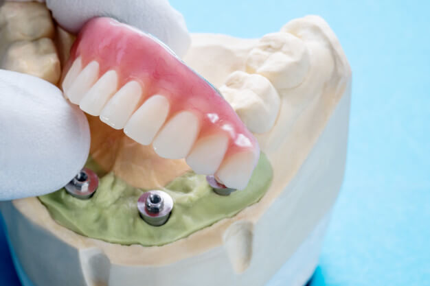 protese fixa dentes