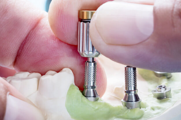 implantodontia dentista colocando pino em protese dentaria