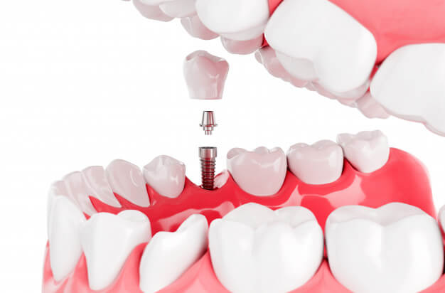 implantodontia protese dentaria