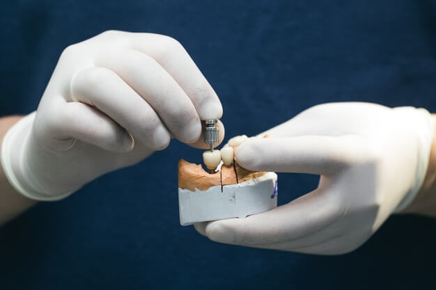 enxerto ósseo dentário dentista segurando prototipo de implante dentario