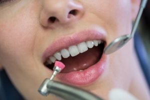 limpeza dentária mulher fazendo tratamento odontologico